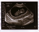 baby_sonogram_1a